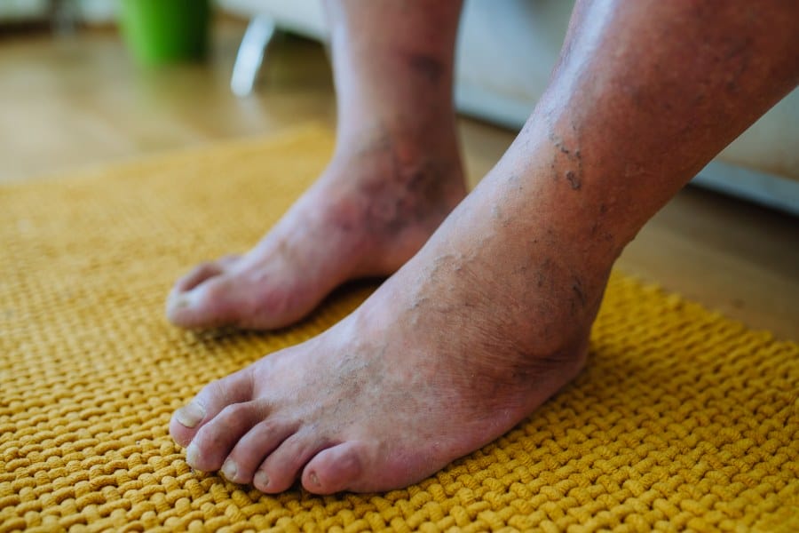 A person with diabetic foot