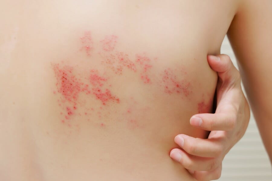 An adult with shingles rashes