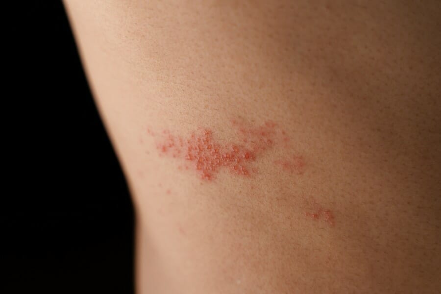 An elderly individual with a rash due to Shingles