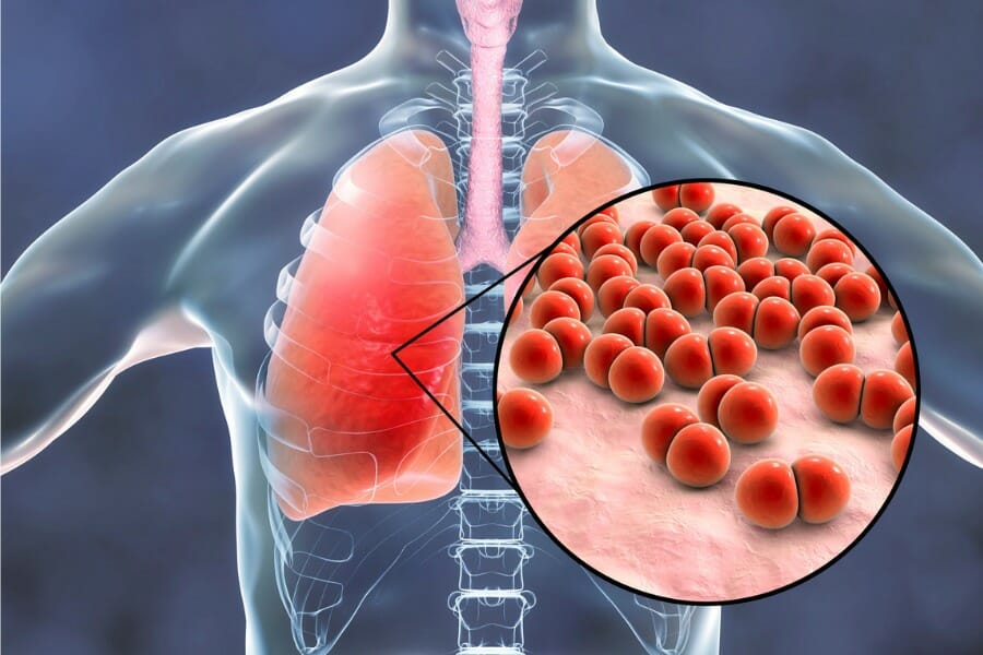 diagram showing what pneumonia is