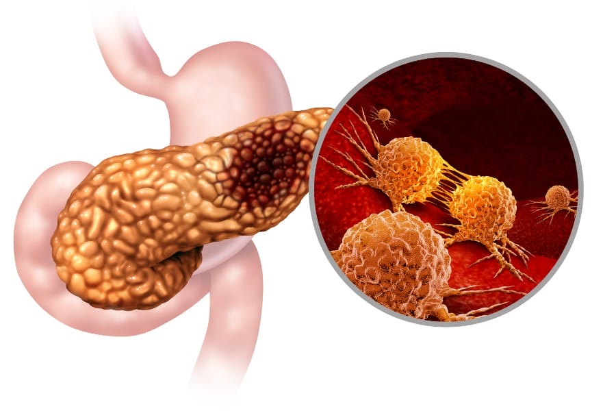 pancreatic cancer diagram