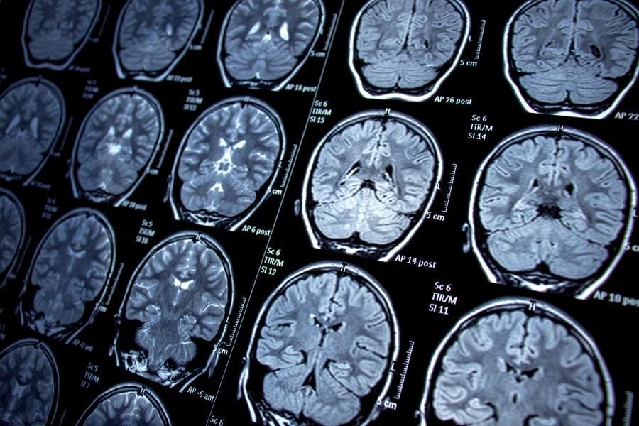 MRI Imaging