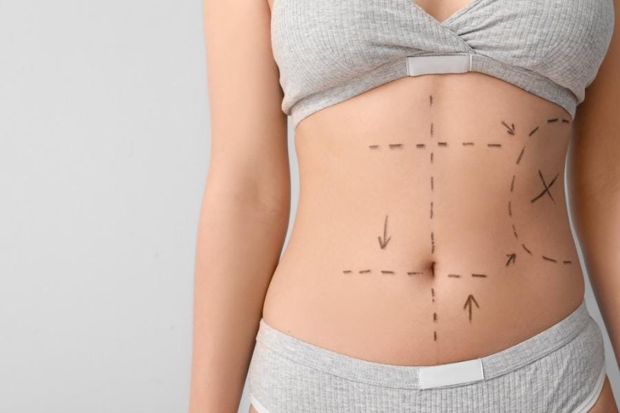 a woman who received a tummy tuck